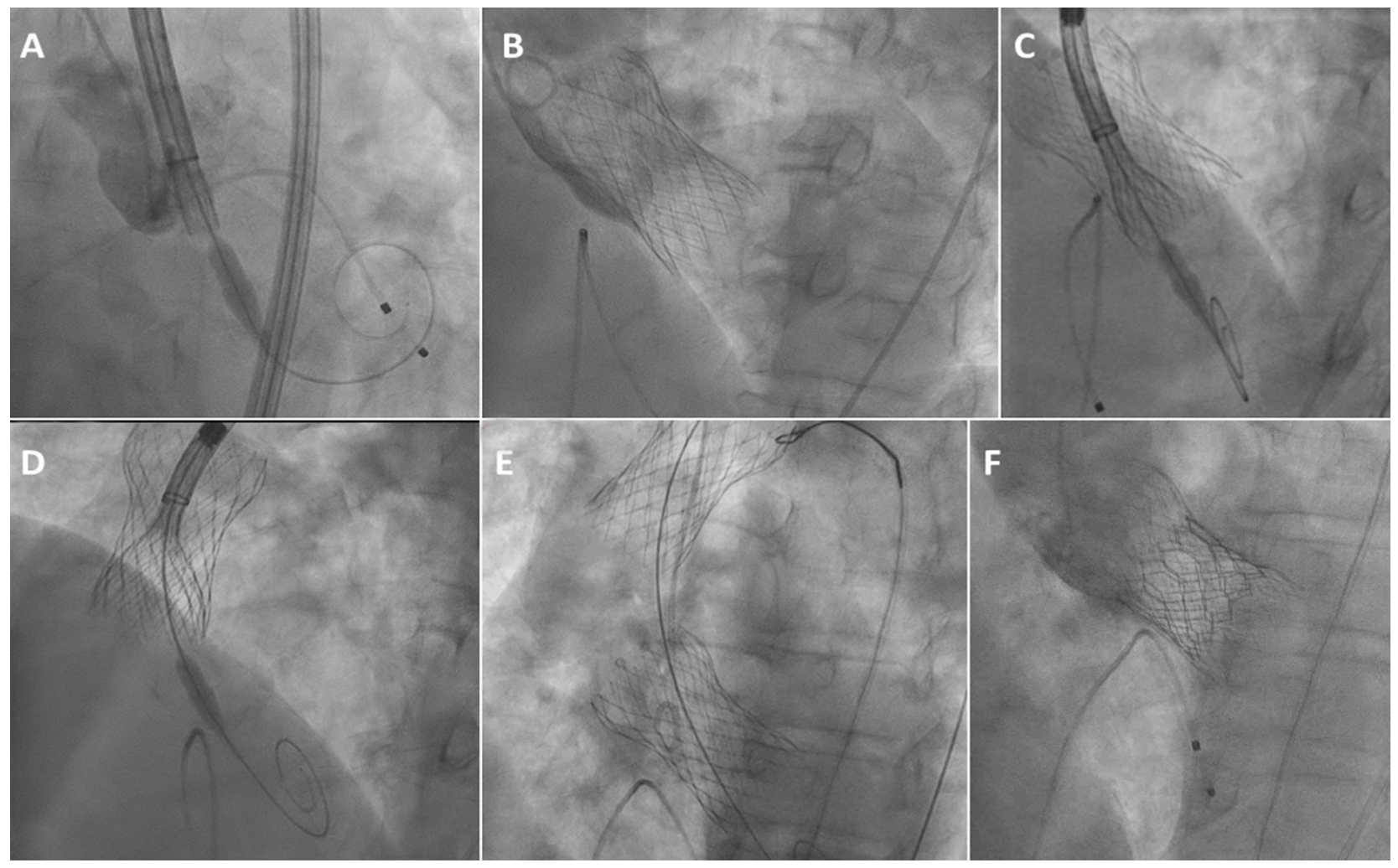 Recurrent Valve Migration During TAVR J Invasive Cardiol